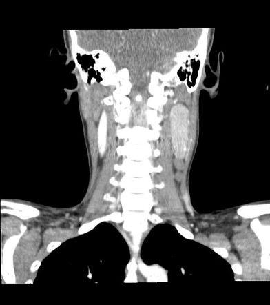 High Attenuation Lymphadenopathy Radiology Reference Article Radiopaedia Org