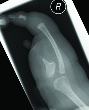 Gollop Wolfgang Complex Radiology Case Radiopaedia Org