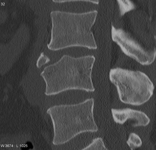 Limbus Vertebra Radiology Case Radiopaedia Org