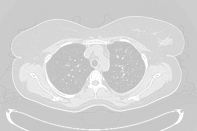 Miliary tuberculosis | Radiology Reference Article | Radiopaedia.org