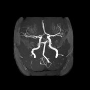 Viewing playlist: MRI brain | Radiopaedia.org