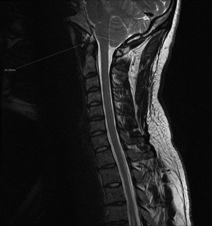 Chiari 1 malformation with focal syrinx | Radiology Case | Radiopaedia.org