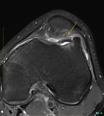 Osteochondritis dissecans - lateral femoral trochlea | Radiology Case ...