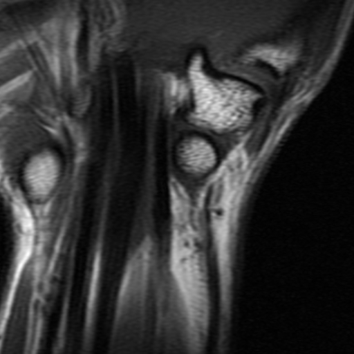 Trapezium exostosis | Image | Radiopaedia.org