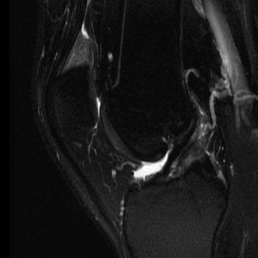 Quadriceps fat pad edema | Image | Radiopaedia.org