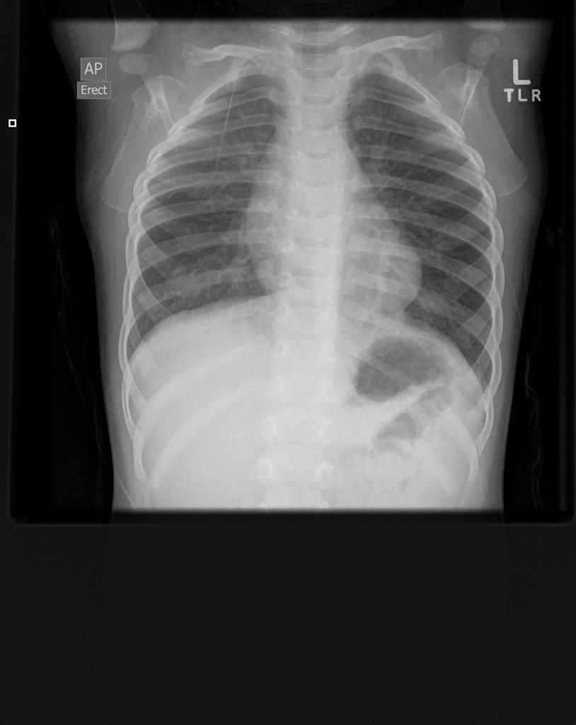 Viral Bronchiolitis Radiology Case Radiopaedia Org