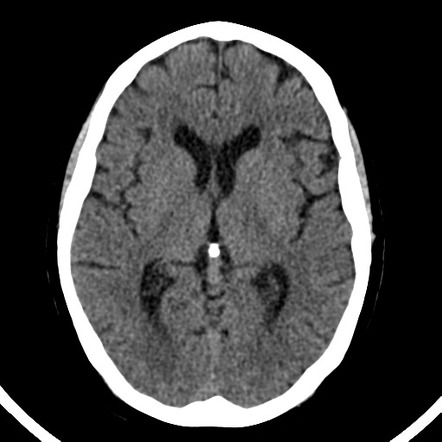 Planum sphenoidale meningioma | Radiology Case | Radiopaedia.org