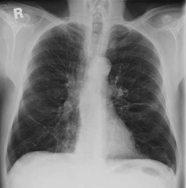 Alpha-1-antitrypsin deficiency | Radiology Reference Article ...