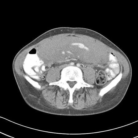 Abdominal desmoid tumour | Radiology Case | Radiopaedia.org