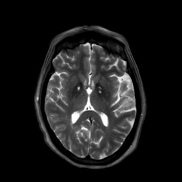 Hallervorden Spatz Syndrome Eye Of The Tiger Sign Radiology Case Radiopaedia Org