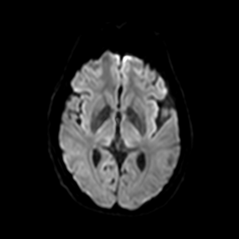 Hallervorden Spatz Syndrome Eye Of The Tiger Sign Image Radiopaedia Org