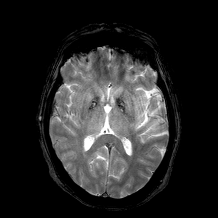 Hallervorden Spatz Syndrome Eye Of The Tiger Sign Image Radiopaedia Org