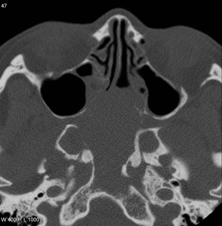 Nasopharyngeal Carcinoma Radiology Case Radiopaedia