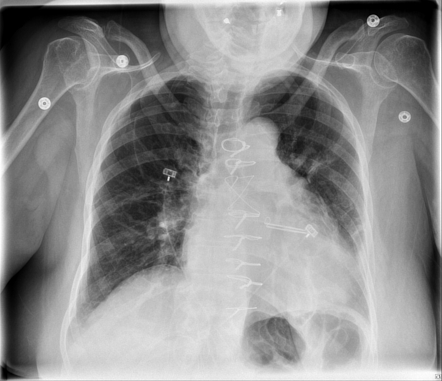 Medical devices in the thorax | Radiology Reference Article ...