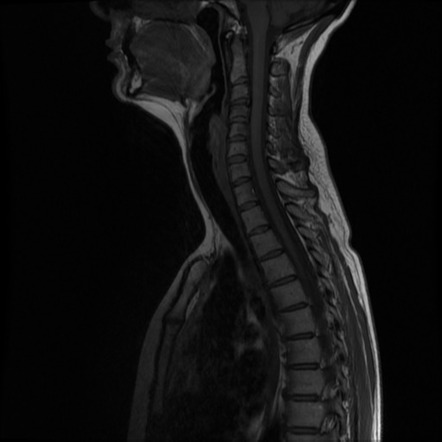 Cerebral autosomal dominant arteriopathy with subcortical infarcts and ...