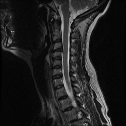 Cerebral autosomal dominant arteriopathy with subcortical infarcts and ...