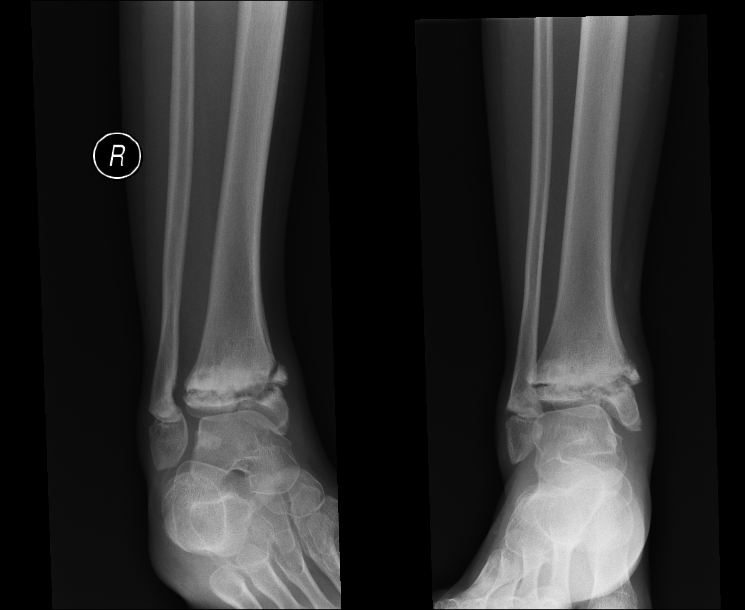 Multicentric osteolysis | Image | Radiopaedia.org