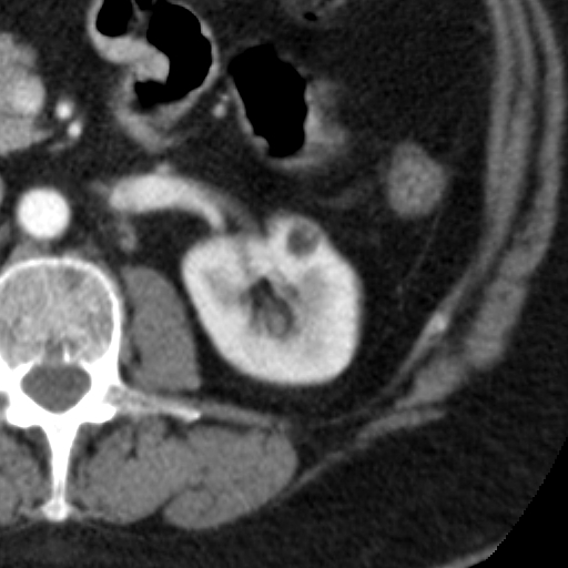 Renal Angiomyolipoma Image