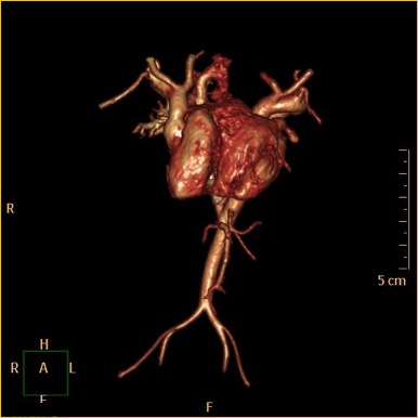 Dicephalus Parapagus Conjoined Twins | Image | Radiopaedia.org