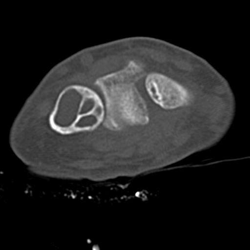 Aneurysmal Bone Cyst Image 1843