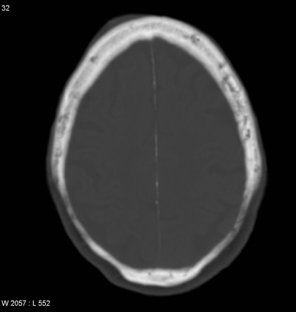 Bilateral thinning of the parietal bones | Radiology Reference Article ...