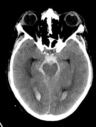 Dissecting aneurysm of the V4 segment of the vertebral artery | Image ...