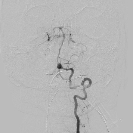 Dissecting aneurysm of the V4 segment of the vertebral artery | Image ...