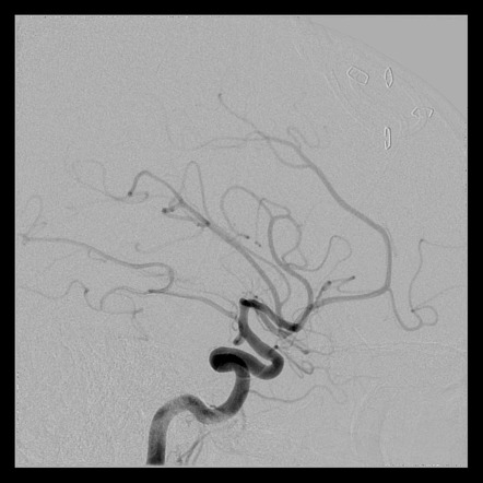 Dissecting aneurysm of the V4 segment of the vertebral artery | Image ...