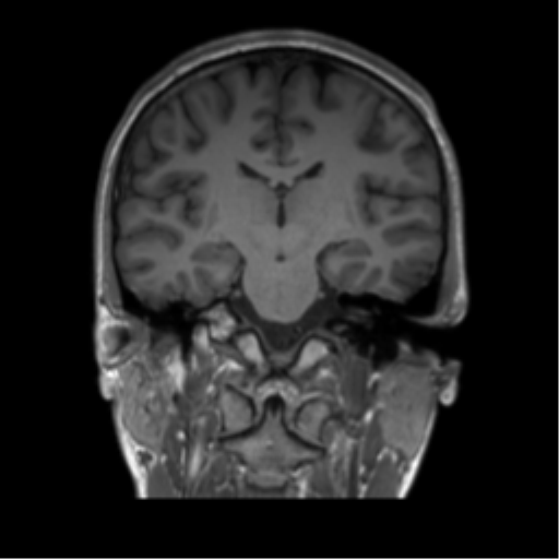 Normal Brain Mri Image