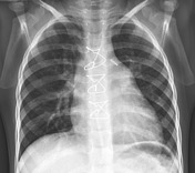 Viewing playlist: Paed - Chest - Clinical Conditions | Radiopaedia.org