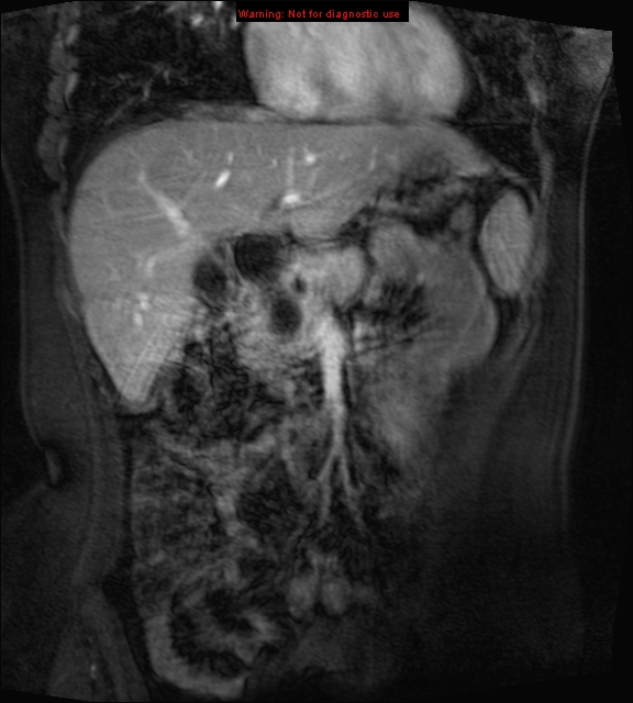 Choledochal Cyst - Type I 