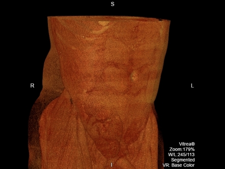 Ipsilateral Spigelian hernia with cryptrochidism | Radiology Case ...