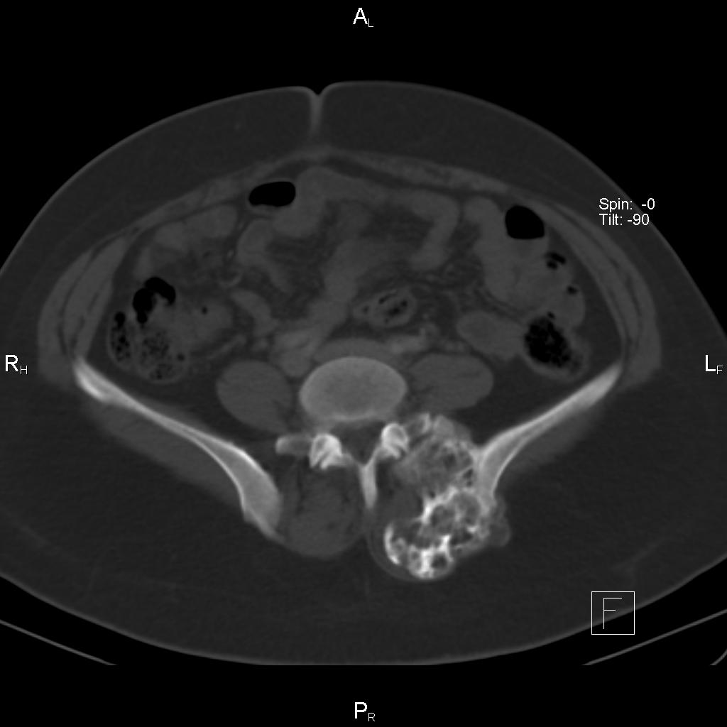 Osteochondroma - Iliac bone | Image | Radiopaedia.org