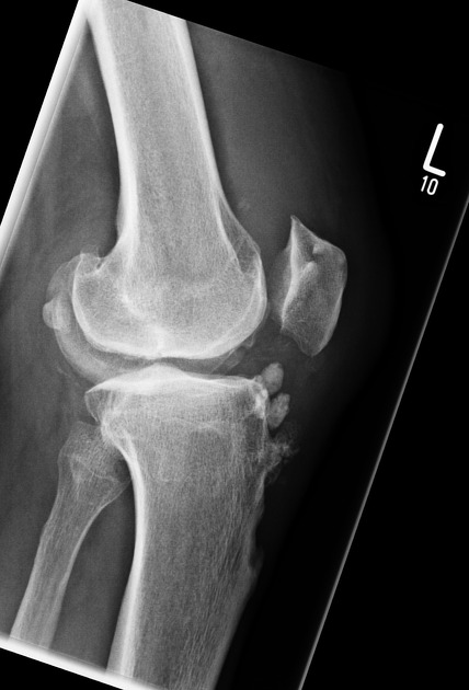 Osgood-Schlatter disease | Radiology Reference Article | Radiopaedia.org