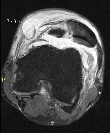 Mpfl And Acl Tears With Patellar Lateralization 