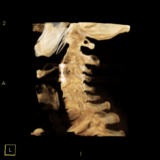 Foramen arcuale atlantis | Image | Radiopaedia.org