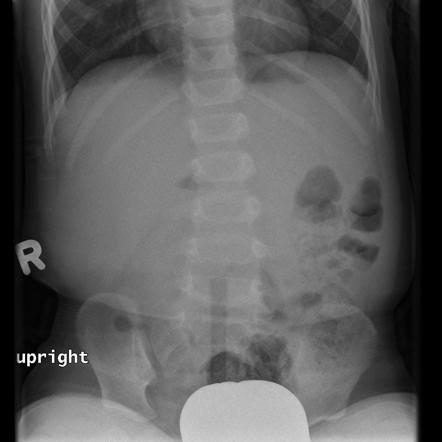 Gasless abdomen | Radiology Reference Article | Radiopaedia.org