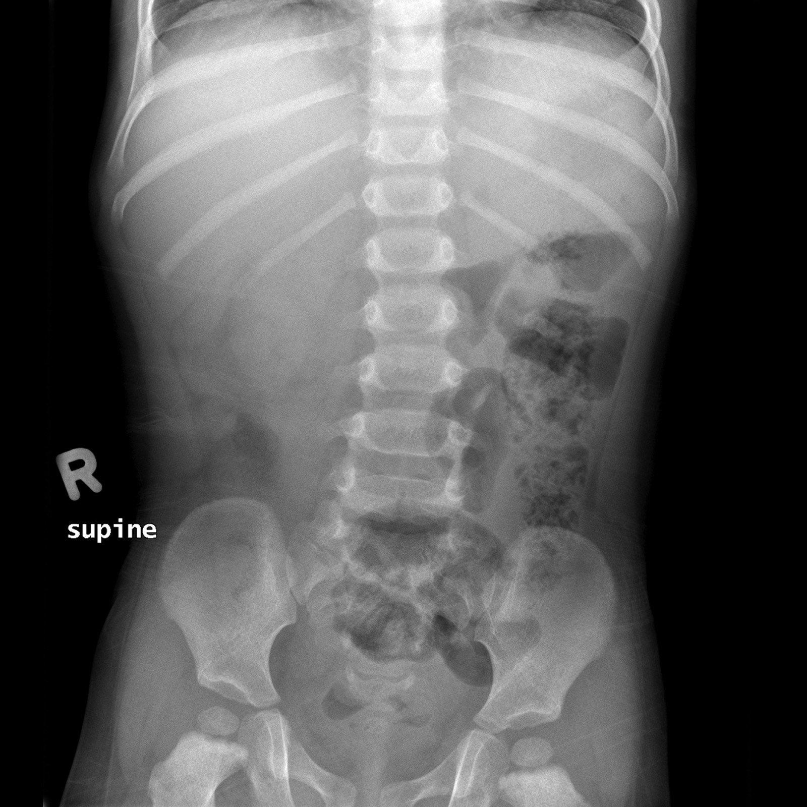 Intussusception | Image | Radiopaedia.org