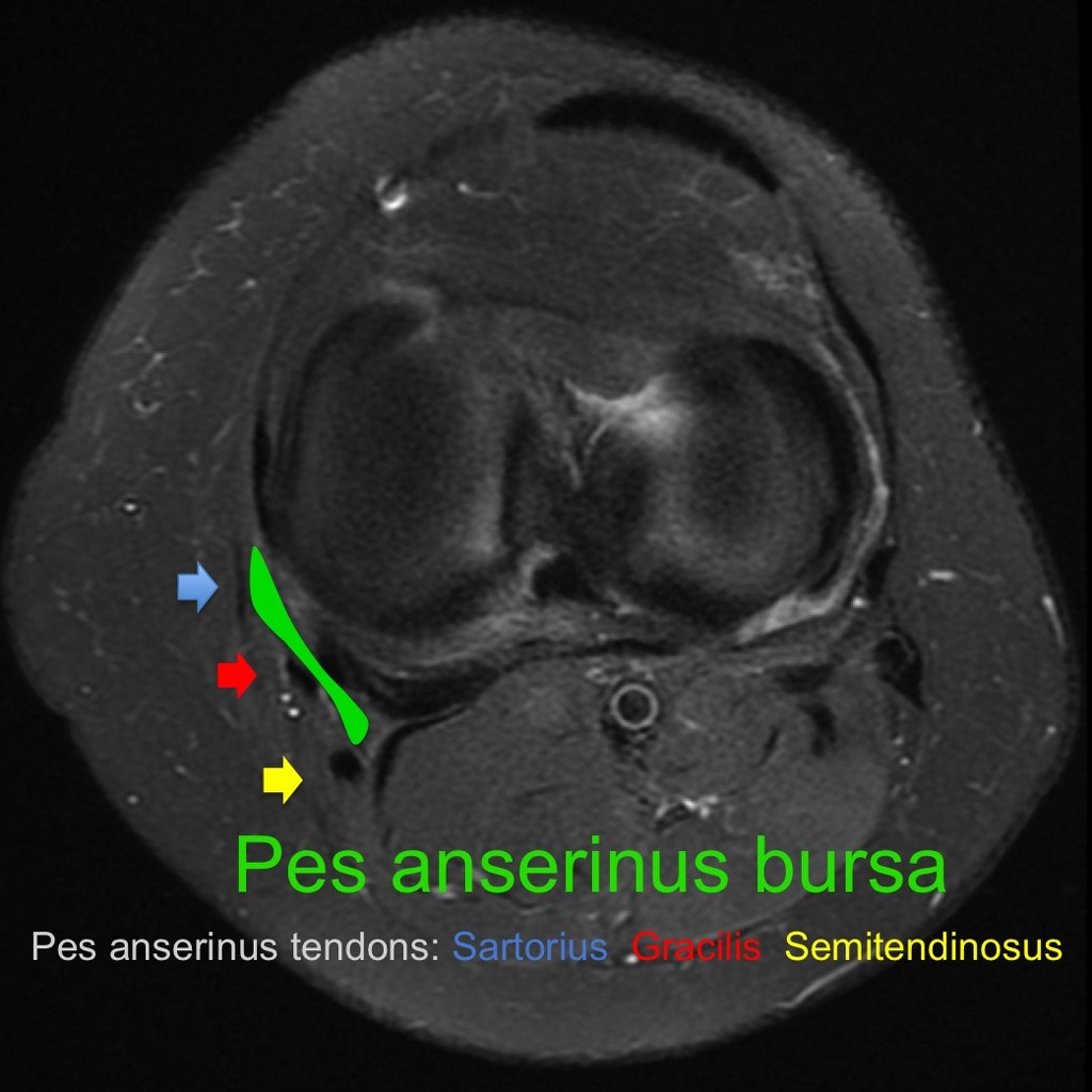 pes anserinus bursitis