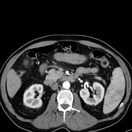 Inflammatory aneurysm of the superior mesenteric artery | Radiology ...