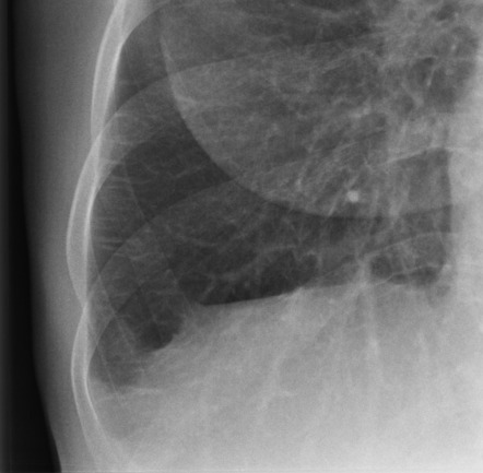 Septal Lines In Lung | Radiology Reference Article | Radiopaedia.org