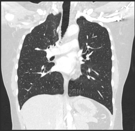 Tracheal bronchus | Image | Radiopaedia.org