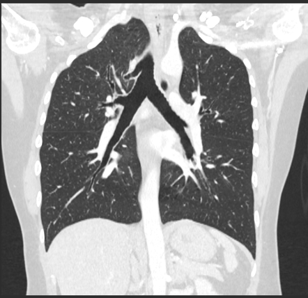 Tracheal bronchus | Radiology Case | Radiopaedia.org