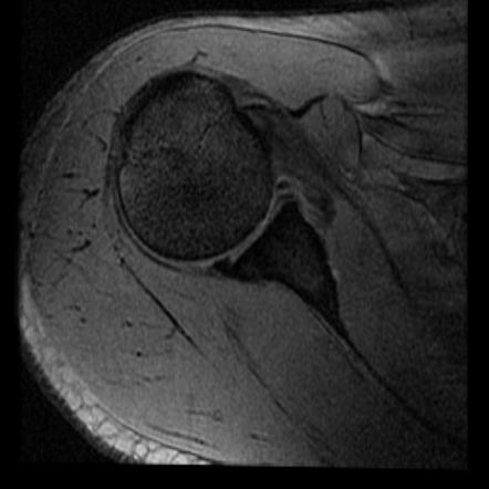 Glenoid Labrum Variants Radiology Reference Article Radiopaedia Org