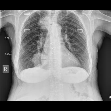 Lung masses | Radiology Case | Radiopaedia.org