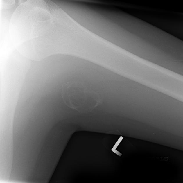 Myositis ossificans | Radiology Reference Article | Radiopaedia.org