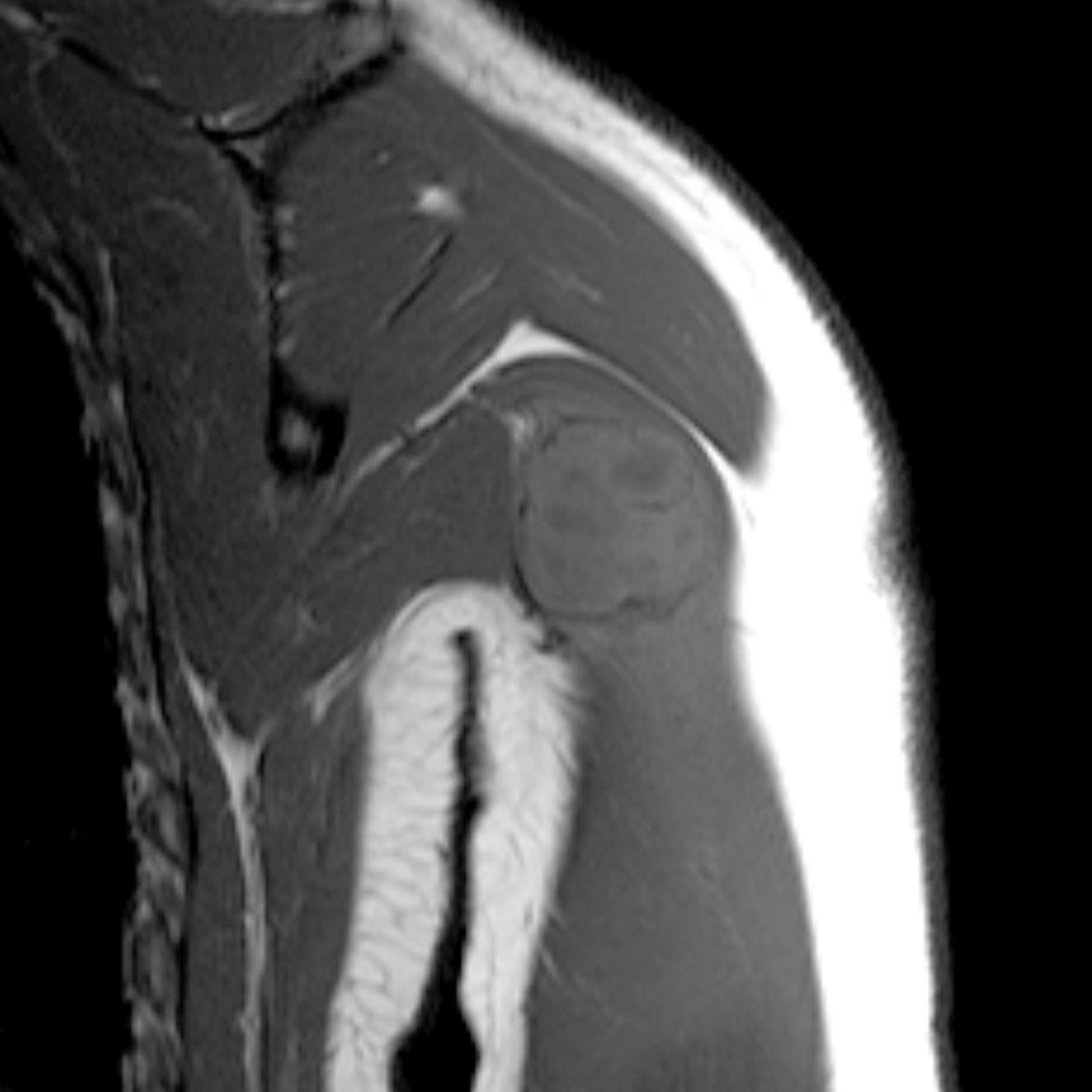 Myositis ossificans - arm | Image | Radiopaedia.org