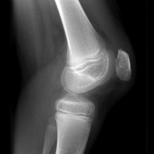 Chondromalacia of shop the patella