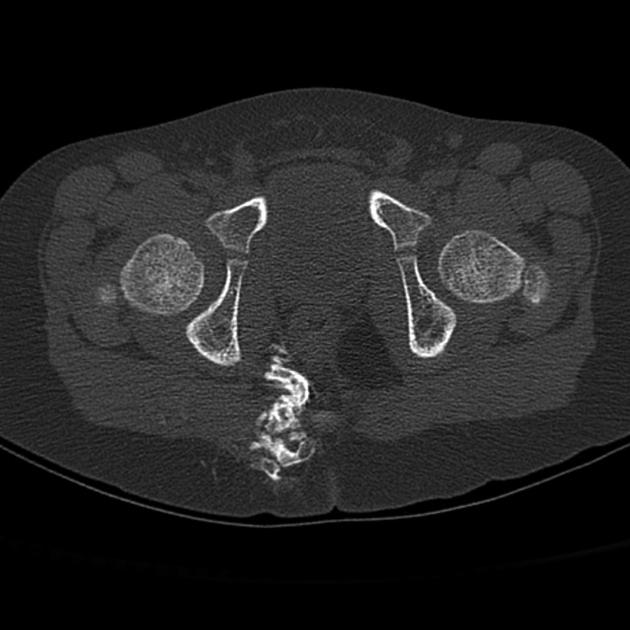 Myositis ossificans | Radiology Reference Article | Radiopaedia.org