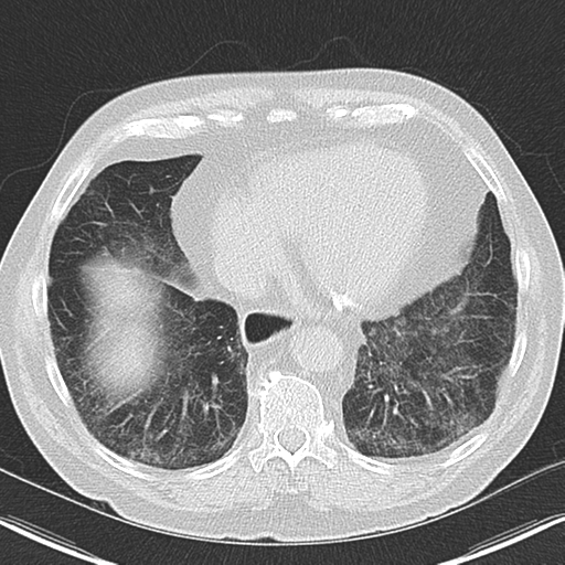 Pulmonary fibrosis - NSIP pattern | Image | Radiopaedia.org